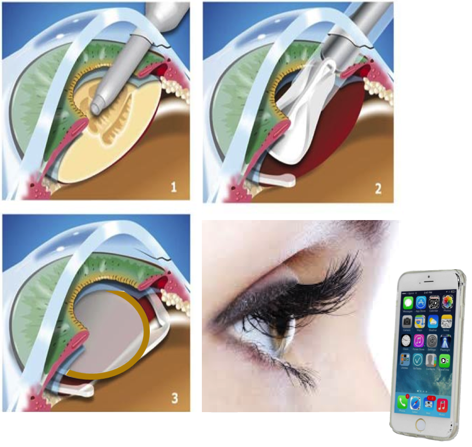 Bohringer_towards-continuous-monitoring-of-intraocular-pressure EDIT